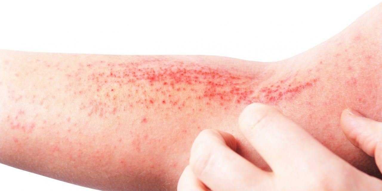 PACIENTES CON DERMATITIS ATÓPICA NO PUEDEN PASAR DESAPERCIBIDOS